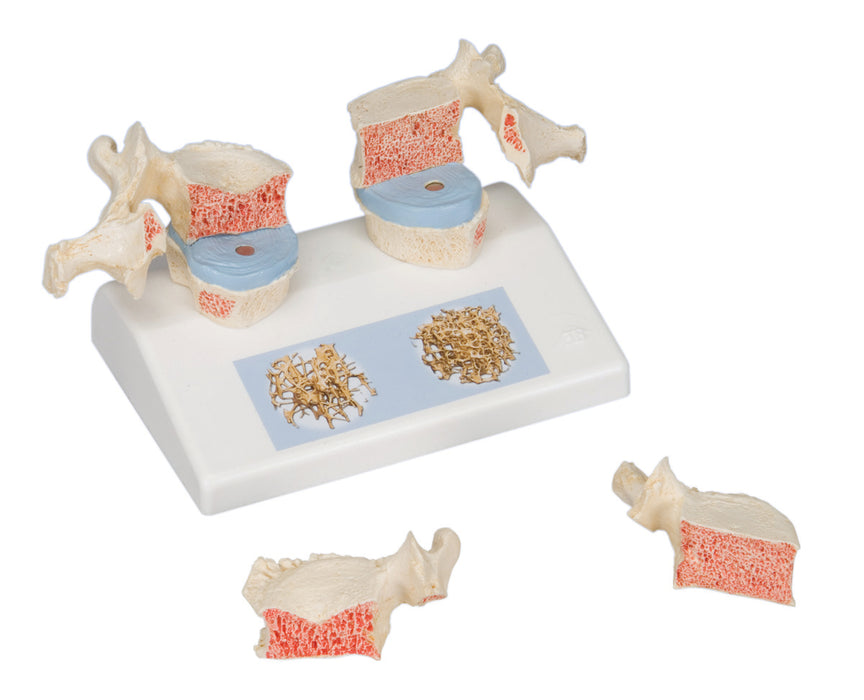 3B Scientific Anatomical Model - Osteoporosis model