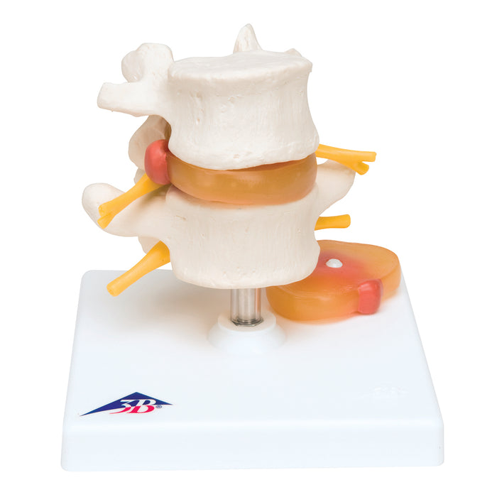 3B Scientific Anatomical Model - Lumbar Spinal Column with Prolapsed Intervertebral Disc