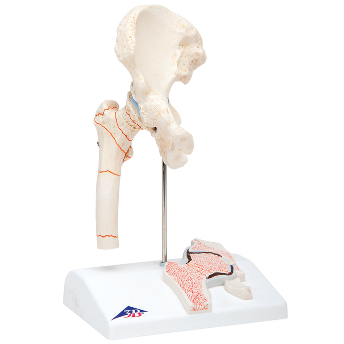 3B Scientific Anatomical Model - Femoral Fracture and Hip Osteoarthritis